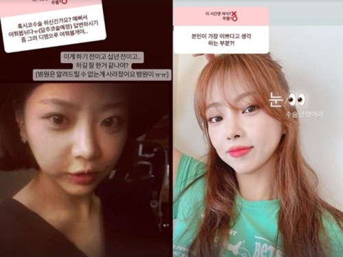 【画像】「鼻を整形」と突然告白、手術前の写真まで…韓国人気恋愛バラエティ出演者のビフォーアフター