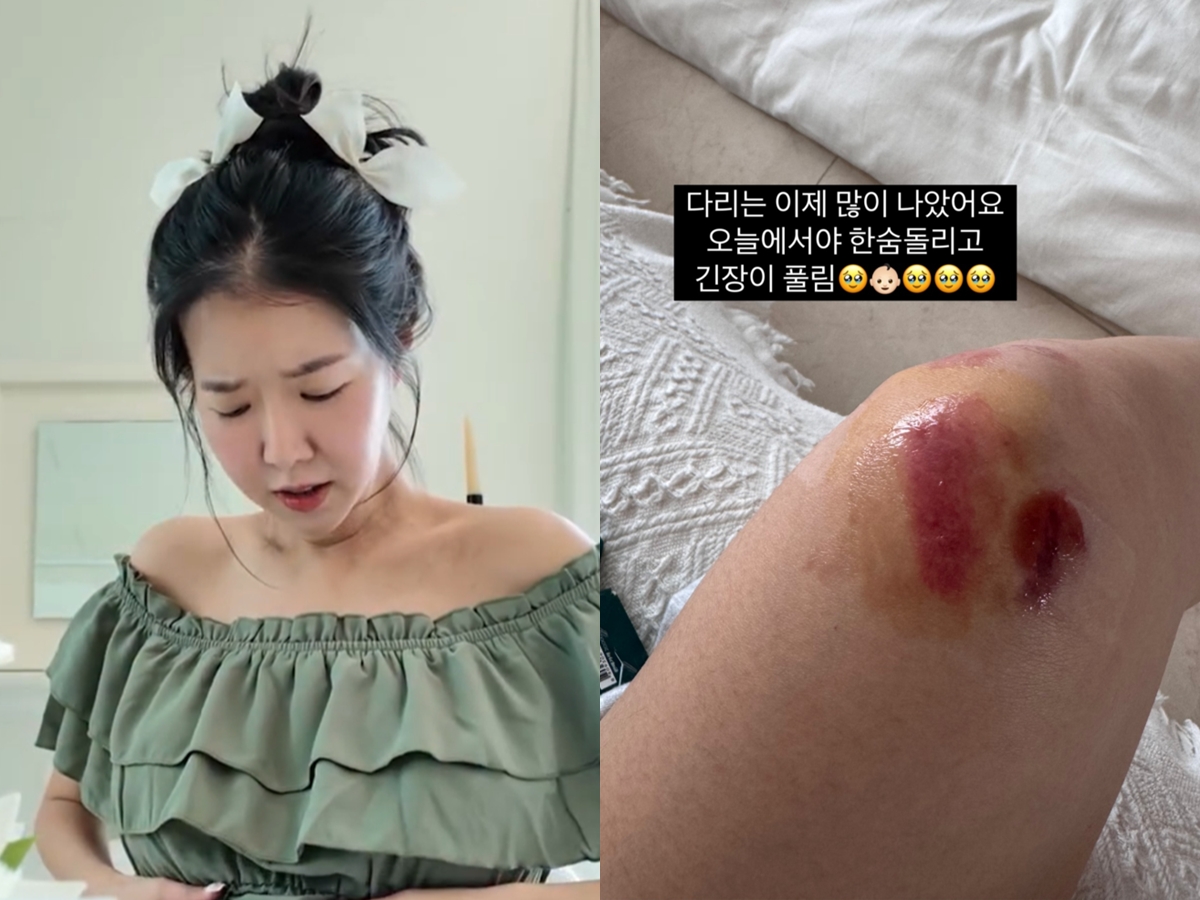 “双子妊娠中”に自宅で大転倒…元K-POPアイドルが痛々しい傷公開　「守れなかった気が」と涙の告白も