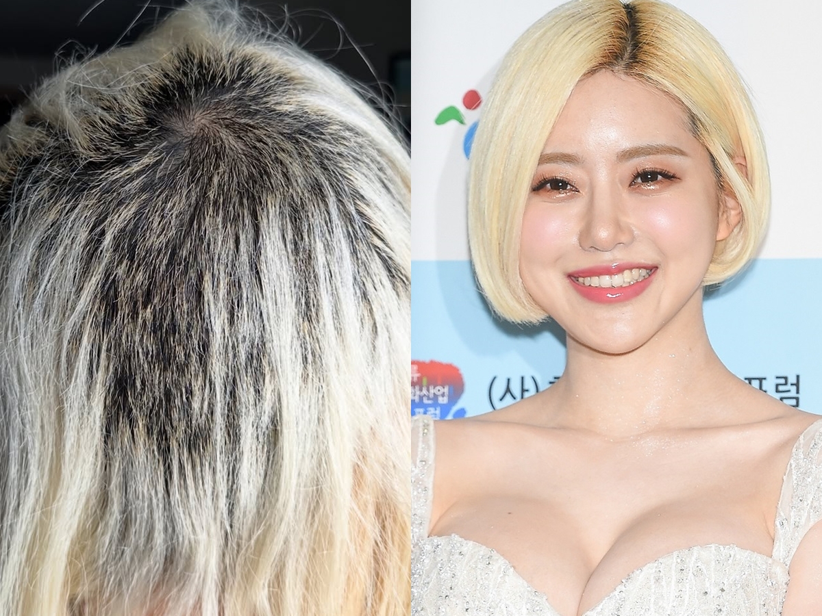 【写真】DJ SODAの頭が無残な状態に「どんどん抜けて…」日本では“性被害”で話題に